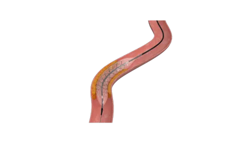 Hybrid FlexyRap - Drug Eluting Coronary Stent - SLTL Medical